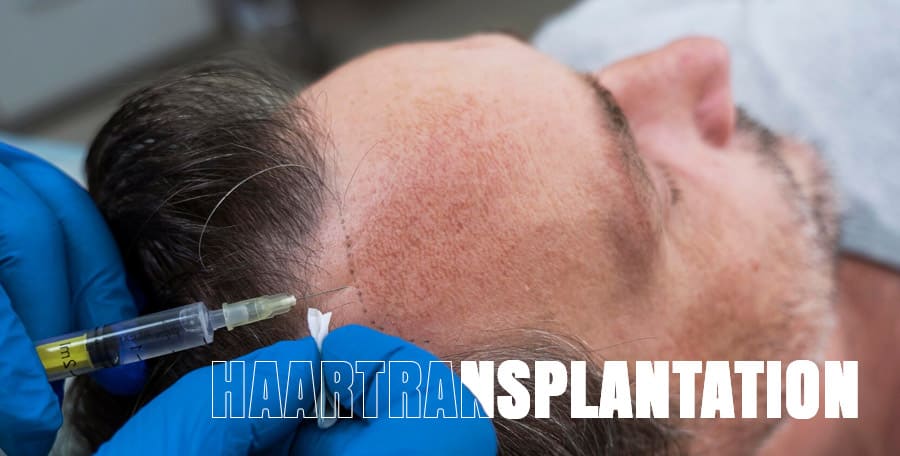 Haartransplantation: Vorteile und Nachteile